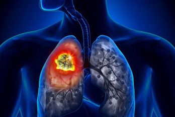 GIẢI ĐÁP: Phát hiện ung thư phổi giai đoạn cuối nên làm gì?